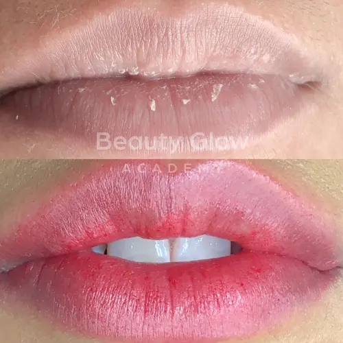 Nanopigmentacao Labial Antes E Depois 1